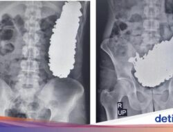 Aneh Tapi Nyata! Pria Hingga Iran Telan 452 Benda Logam, Baut hingga Mur