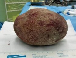 Penampakan Batu Kandung Kemih Bak Telur Raksasa, Beratnya Hampir 1 Kg
