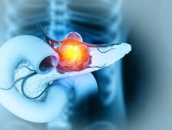 Dikira Sakit Punggung Biasa, Pria Ini Ternyata Idap Kanker Pankreas