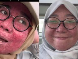 Wanita Jaksel Breakout Parah, Alami Tanda-Tanda Ini Pasca Stop Skincare Steroid