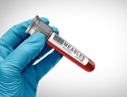 IDAI Beberkan Tanda Ruam Akibat Campak Vs Cacar Air, Kerap Dikatakan Mirip