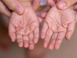 Tanda Campak yang Harus Diwaspadai Ortu, Kasusnya Lagi Naik Ke RI