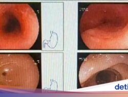 Gegara Makan Hotpot Panas, Kerongkongan Wanita Ini Luka Sepanjang 8 Cm